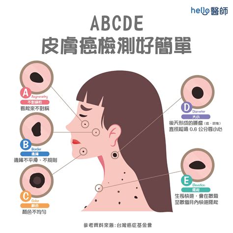 身體長誌|痣變大、痣多或長毛會變皮膚癌？認識痣的形成與原因